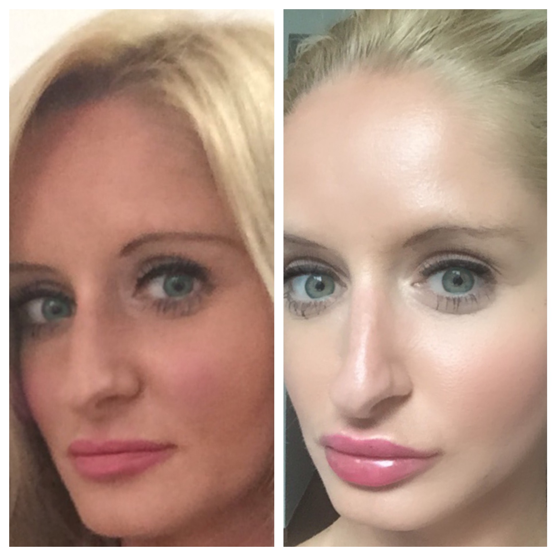 The gallery for --&gt; Hyaluronic Acid Cream Before After